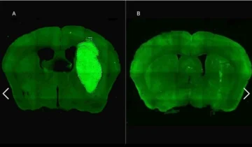 Científicos del CONICET lograron frenar un tipo de cáncer cerebral